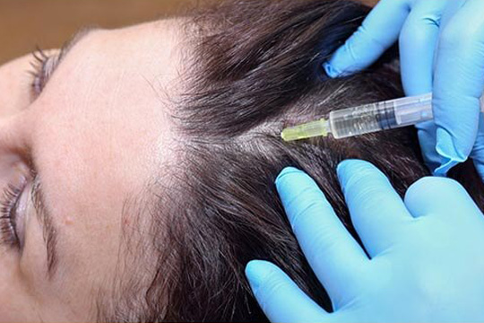 Alopecia Areata Treatment in Gurgaon