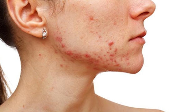 best acne treatment in gurgaon