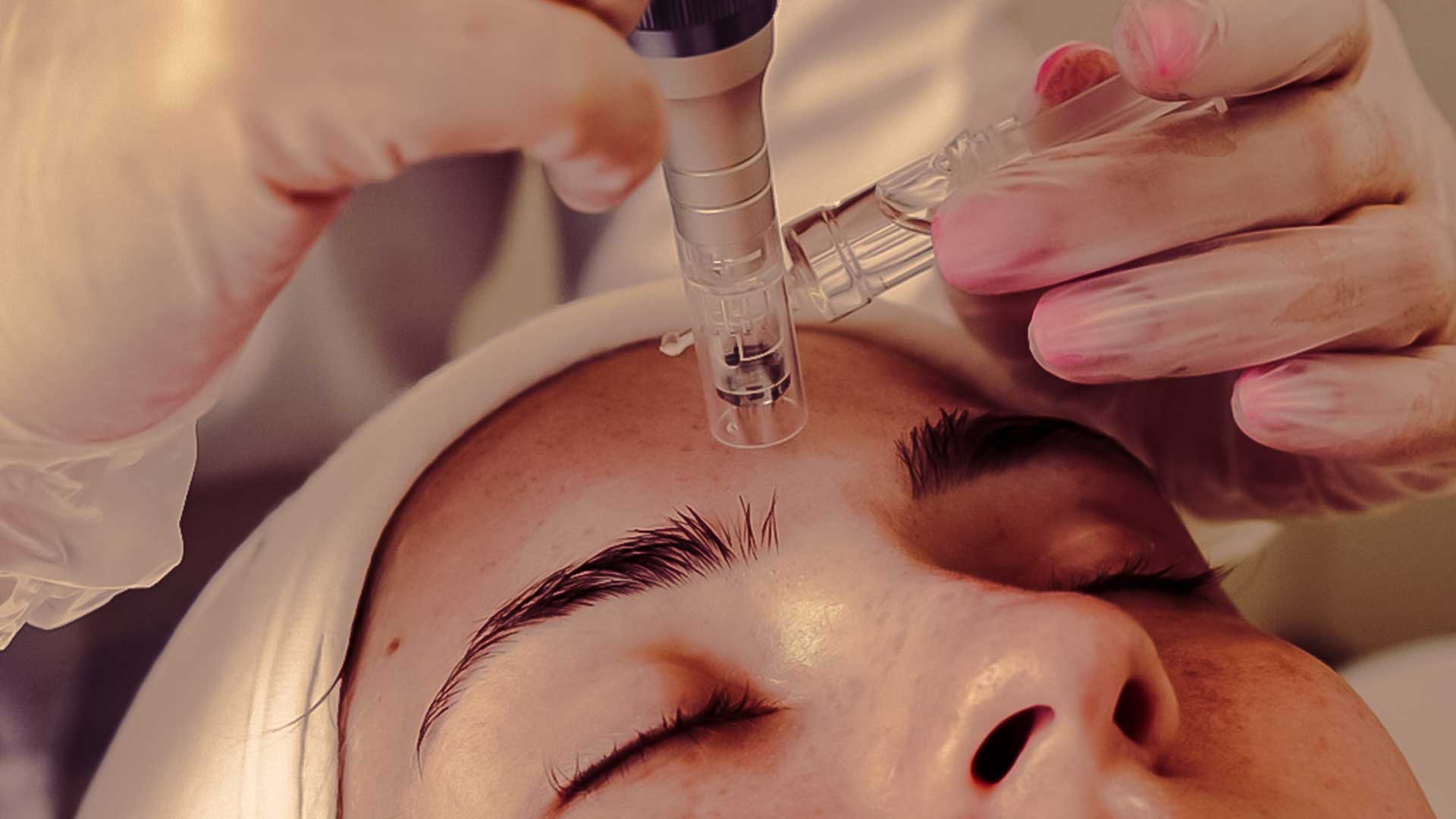 Microneedling Treatment Gurgaon | Garekars M.D. Dermatology Clinic